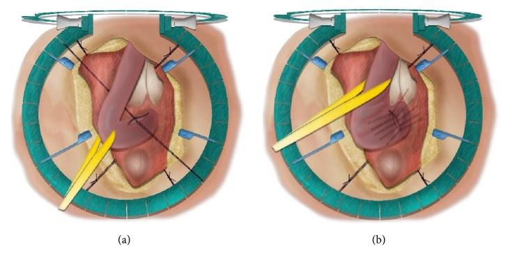Heineke-Mikulicz stricturoplasty of the urethra through a perineal exposure: longitudinal incision, then transverse closure