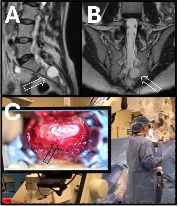 Sagittal and coronal T2-weighted MRI of a left S3 Tarlov cyst with sacral bony erosion, and the cyst seen on the operating microscope monitor