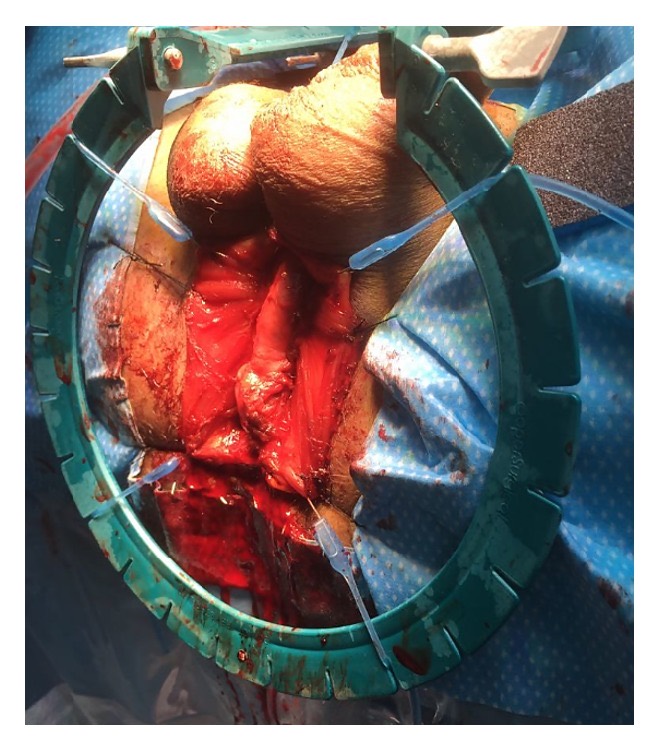 Perineal exposure of the bulbar urethra held with four stay sutures inside a ring retractor